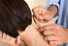 Acupuncture