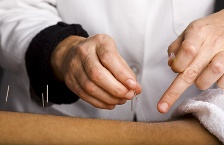 Acupuncture